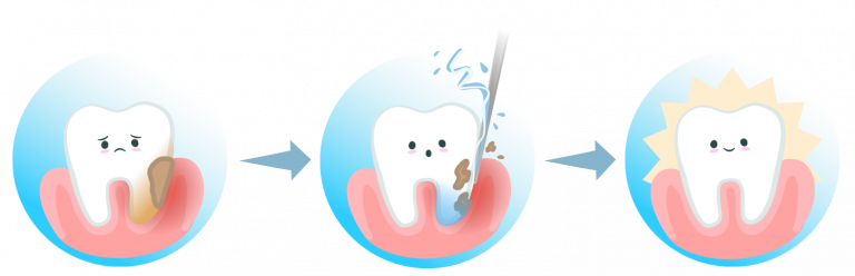 Drei Icons mit Zähnen zeigen die Vorteile und den Verlauf der schmerzarmen Parodontitisbehandlung